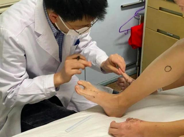 世界首创！北京积水潭医院使用3D打印技术为患者再造拇指
